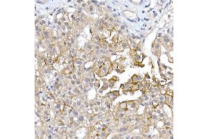 Immunohistochemistry of paraffin-embedded human liver cancer using  Rabbit pAb (ABIN6133588, ABIN6137055, ABIN6137056 and ABIN6224634) at dilution of 1:150 (40x lens). (AQP9 抗体  (AA 50-150))