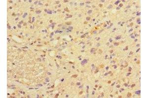 Immunohistochemistry of paraffin-embedded human glioma using ABIN7165067 at dilution of 1:100