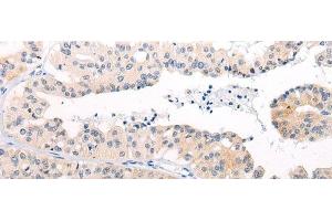 Immunohistochemistry of paraffin-embedded Human liver cancer tissue using ANAPC15 Polyclonal Antibody at dilution of 1:50(x200) (ANAPC15 抗体)