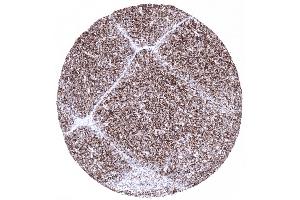 A strong CD1a immunostaining is seen in 80 of small lymphocytes in the thymic cortex (Recombinant CD1a 抗体)
