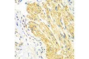 Immunohistochemistry of paraffin-embedded human gastric cancer using PTK6 antibody at dilution of 1:100 (x400 lens). (PTK6 抗体)