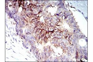 Immunohistochemical analysis of paraffin-embedded rectum cancer tissues using IGF1R antibody with DAB staining. (IGF1R 抗体)