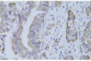 Immunohistochemistry of paraffin-embedded Human liver cancer using CDKN1A Polyclonal Antibody at dilution of 1:100 (40x lens). (p21 抗体)