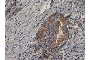 Immunohistochemical staining of paraffin-embedded Adenocarcinoma of Human colon tissue using anti-BCAR1 mouse monoclonal antibody. (BCAR1 抗体)