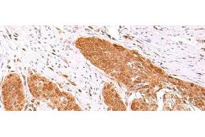 Immunohistochemistry of paraffin-embedded Human esophagus cancer tissue using FDPS Polyclonal Antibody at dilution of 1:60(x200) (FDPS 抗体)