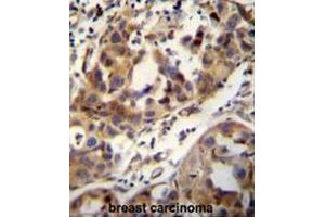 CCDC17 antibody (C-term) immunohistochemistry analysis in formalin fixed and paraffin embedded human breast carcinoma followed by peroxidase conjugation of the secondary antibody and DAB staining. (CCDC17 抗体  (C-Term))