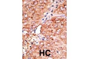Formalin-fixed and paraffin-embedded human cancer tissue reacted with the primary antibody, which was peroxidase-conjugated to the secondary antibody, followed by AEC staining. (CCBP2 抗体  (C-Term))