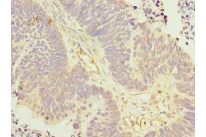 Immunohistochemistry of paraffin-embedded human ovarian cancer using ABIN7157306 at dilution of 1:100 (KLHDC5 抗体  (AA 1-410))