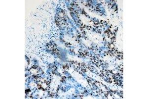Immunohistochemical analysis of DACH1 staining in human colon cancer formalin fixed paraffin embedded tissue section. (DACH1 抗体)