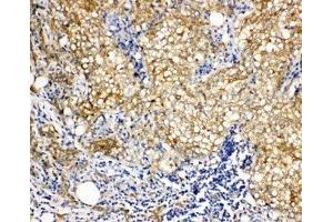 IHC-P: Vinculin antibody testing of human breast cancer tissue (Vinculin 抗体  (AA 173-188))