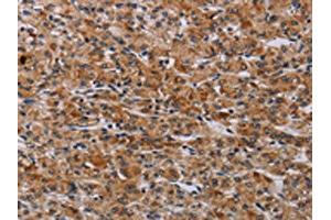 The image on the left is immunohistochemistry of paraffin-embedded Human prostate cancer tissue using ABIN7190614(F2RL2 Antibody) at dilution 1/30, on the right is treated with synthetic peptide. (F2RL2 抗体)