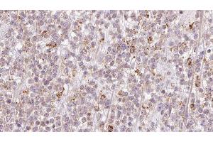 ABIN6273206 at 1/100 staining Human lymph cancer tissue by IHC-P. (CCDC93 抗体  (C-Term))