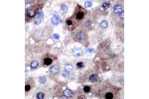Immunohistochemical analysis of SULT2B1 staining in human liver cancer formalin fixed paraffin embedded tissue section. (SULT2B1 抗体)