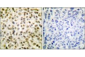 Immunohistochemistry analysis of paraffin-embedded human breast carcinoma tissue, using Histone H1 (Acetyl-Lys25) Antibody. (Histone H1 抗体  (acLys25))