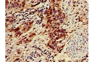 Immunohistochemistry of paraffin-embedded human bladder cancer using ABIN7176497 at dilution of 1:100 (ZNF695 抗体  (AA 1-88))