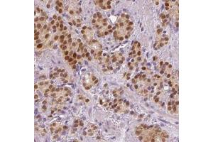 IHC analysis of paraffin-embedded human prostate cancer tissue, using SPOP antibody (1/200 dilution). (SPOP-B 抗体)