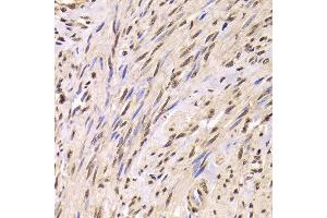 Immunohistochemistry of paraffin-embedded Human adenomyosis using SNRPA antibody at dilution of 1:100 (x400 lens). (SNRPA1 抗体)