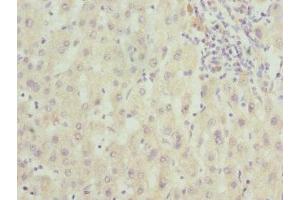Immunohistochemistry of paraffin-embedded human liver cancer using ABIN7166597 at dilution of 1:100 (Small EDRK-Rich Factor 1A (SERF1A) (AA 140-240) 抗体)