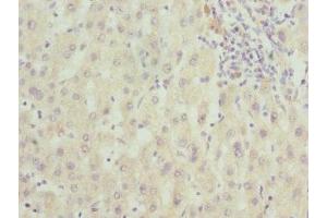 Immunohistochemistry of paraffin-embedded human liver cancer using ABIN7166597 at dilution of 1:100 (FAM20A 抗体  (AA 140-240))