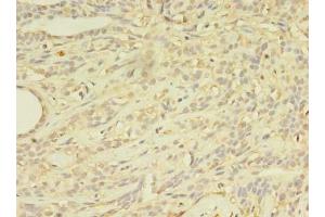Immunohistochemistry of paraffin-embedded human breast cancer using ABIN7144889 at dilution of 1:100 (ABCB5 抗体  (AA 547-760))