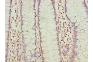 Immunohistochemistry of paraffin-embedded human colon cancer using ABIN7152521 at dilution of 1:100 (FAD Synthetase 抗体  (AA 1-490))
