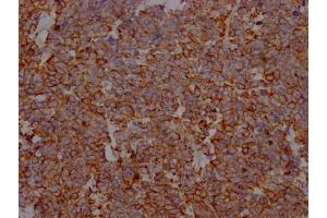 IHC image of ABIN7127670 diluted at 1:100 and staining in paraffin-embedded human lung cancer performed on a Leica BondTM system. (Recombinant PD-L1 抗体)