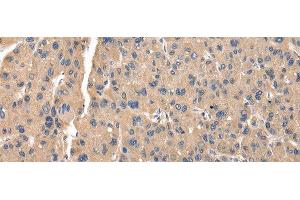 Immunohistochemistry of paraffin-embedded Human thyroid cancer tissue using ZFAND5 Polyclonal Antibody at dilution of 1:35(x200) (ZFAND5 抗体)