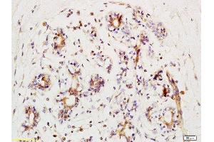 Formalin-fixed and human kidney carcinoma tissue labeled with Anti-phospho-BACH1/BRIP1(Ser990) Polyclonal Antibody, Unconjugated  at 1:200 followed by conjugation to the secondary antibody and DAB staining (BRIP1 抗体  (pSer990))