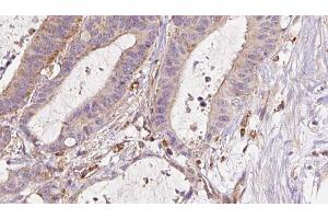 ABIN6273044 at 1/100 staining Human liver cancer tissue by IHC-P. (ETFB 抗体  (Internal Region))