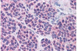 Anti-MBOAT4 antibody  ABIN960793 IHC staining of human thyroid, medullary carcinoma. (MBOAT4 抗体  (Internal Region))