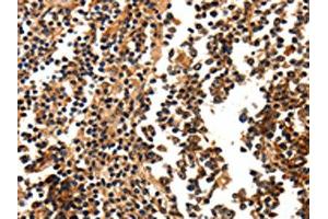 The image on the left is immunohistochemistry of paraffin-embedded Human tonsil tissue using ABIN7190676(FOXB2 Antibody) at dilution 1/5, on the right is treated with synthetic peptide. (FOXB2 抗体)
