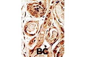 Formalin-fixed and paraffin-embedded human cancer tissue reacted with the primary antibody, which was peroxidase-conjugated to the secondary antibody, followed by AEC staining. (SENP3 抗体  (N-Term))