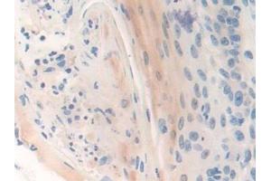 Detection of CENPI in Human Skin cancer Tissue using Polyclonal Antibody to Centromere Protein I (CENPI) (CENPI 抗体  (AA 292-528))