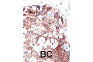 Formalin-fixed and paraffin-embedded human cancer tissue reacted with UBQLN1 polyclonal antibody  , which was peroxidase-conjugated to the secondary antibody, followed by DAB staining. (Ubiquilin 1 抗体  (N-Term))