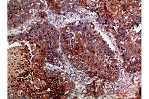 Immunohistochemical analysis of paraffin-embedded human-lung-cancer, antibody was diluted at 1:200 (MLL/KMT2A 抗体  (AA 3850-3900))