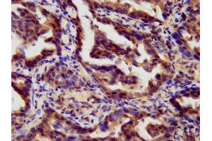 IHC image of ABIN7167803 diluted at 1:300 and staining in paraffin-embedded human lung cancer performed on a Leica BondTM system. (Retinoic Acid Receptor gamma 抗体  (AA 13-87))