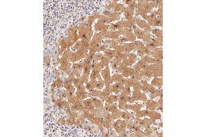 Immunohistochemical analysis of paraffin-embedded Human hepatocarcinoma tissue using (ABIN657465 and ABIN2846493) performed on the Leica® BOND RXm. (Lactate Dehydrogenase A 抗体  (C-Term))