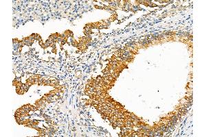 ABIN6257600 and ABIN6275123 at 1/100 staining Human colorectal cancer by IHC-P.