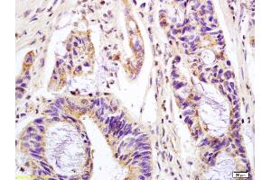 Formalin-fixed and paraffin embedded human colon carcinoma labeled with Anti-phospho-MAPK11(Thr180+Tyr182) Polyclonal Antibody, Unconjugated (ABIN710576) at 1:200 followed by conjugation to the secondary antibody and DAB staining.