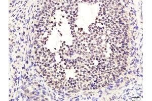 Immunohistochemistry (Paraffin-embedded Sections) (IHC (p)) image for anti-Estrogen Receptor 1 (ESR1) (pSer118) antibody (ABIN684568)