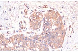 Immunohistochemistry of paraffin-embedded Human mammary cancer using Caspase-3 Polyclonal Antibody at dilution of 1:200 (40x lens). (Caspase 3 抗体)