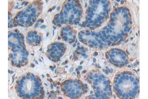 DAB staining on IHC-P; Samples: Human Breast cancer Tissue (Annexin A3 抗体  (AA 19-154))