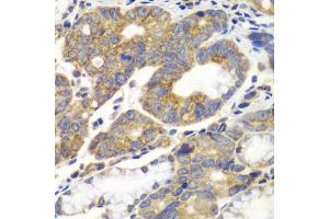 Immunohistochemistry of paraffin-embedded human gastric cancer using PFKM antibody. (PFKM 抗体)