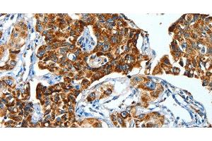 Immunohistochemistry of paraffin-embedded Human lung cancer using ALDH6A1 Polyclonal Antibody at dilution of 1:45 (ALDH6A1 抗体)