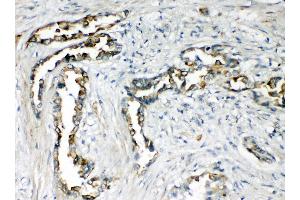 Anti-CXCR1 antibody, IHC(P) IHC(P): Human Lung Cancer Tissue (CXCR1 抗体  (N-Term))