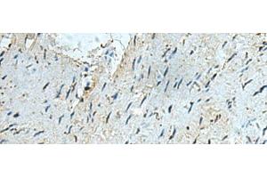 Immunohistochemistry of paraffin-embedded Human gastric cancer tissue using RAPSN Polyclonal Antibody at dilution of 1:40(x200) (RAPSN 抗体)