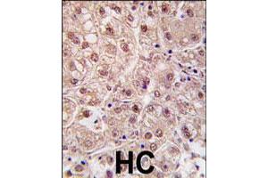 Formalin-fixed and paraffin-embedded human hepatocellular carcinoma reacted with PSMA5 polyclonal antibody  , which was peroxidase-conjugated to the secondary antibody, followed by DAB staining. (PSMA5 抗体  (N-Term))