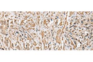 Immunohistochemistry of paraffin-embedded Human prost ate cancer tissue using CNPY2 Polyclonal Antibody at dilution of 1:25(x200) (CNPY2/MSAP 抗体)