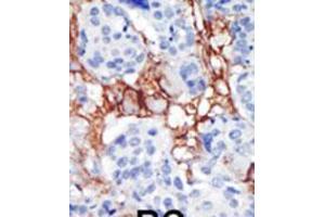 Formalin-fixed and paraffin-embedded human cancer tissue reacted with the primary antibody, which was peroxidase-conjugated to the secondary antibody, followed by AEC staining. (PIP4K2B 抗体  (C-Term))