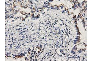 Immunohistochemical staining of paraffin-embedded Carcinoma of Human lung tissue using anti-PNMT mouse monoclonal antibody. (PNMT 抗体)